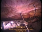 Minimally Invasive Functional Repair Of The Abdominal Wall In Multiple/ Trocar Site Ventral Hernias